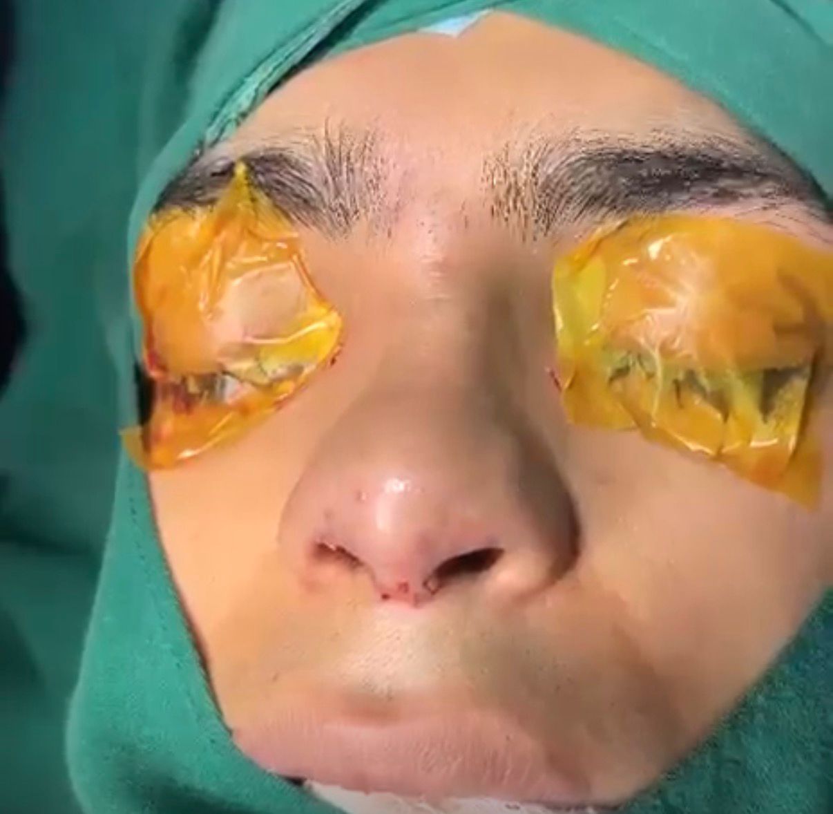 Pre-Op